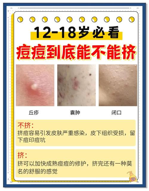 祛痘精华真能预防痘痘吗？-图3