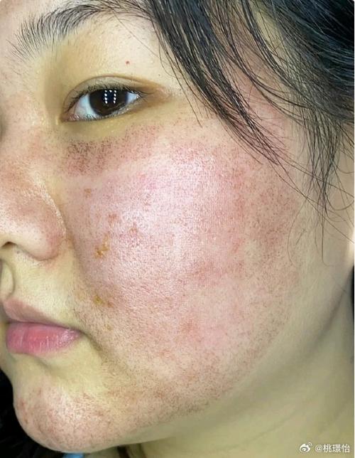 激光祛斑部位总是长痘-图2