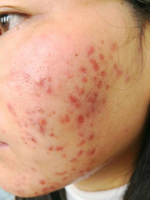 激光祛斑部位总是长痘-图1