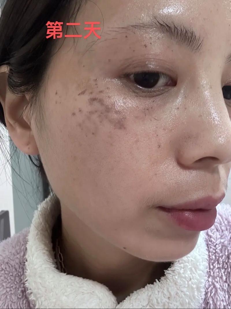激光祛斑部位总是长痘-图3