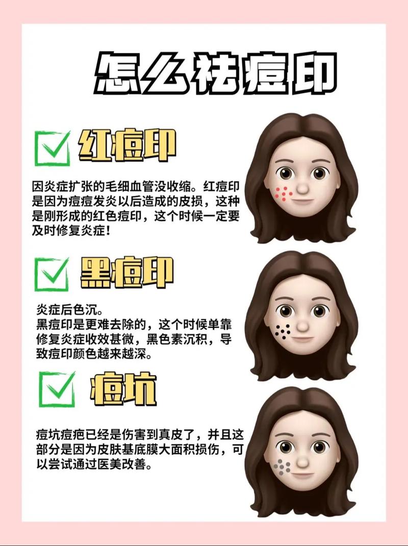 夏天祛痘印用什么方法好？-图2