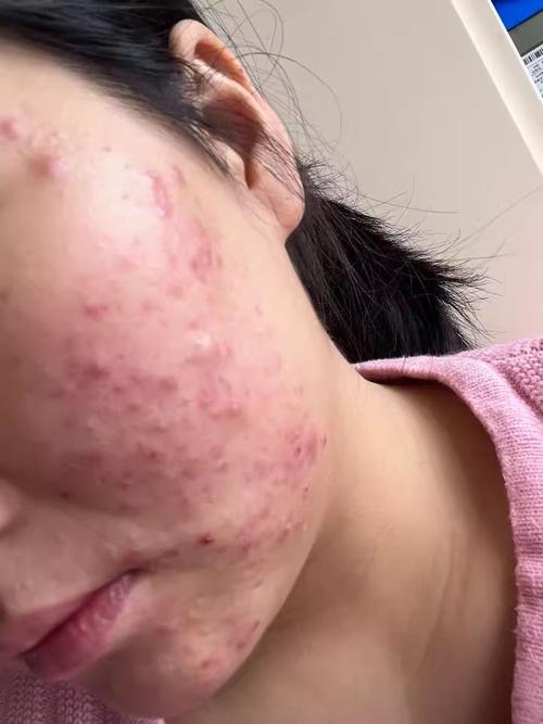 祛痘产品用后皮肤为何会暗沉？-图1