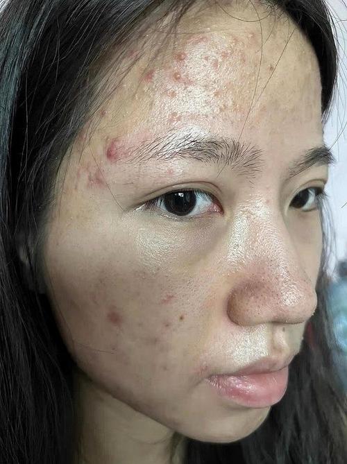 祛痘产品用后皮肤为何会暗沉？-图2