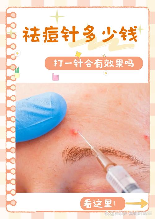 白头痘痘祛痘针真的最好用吗？-图2