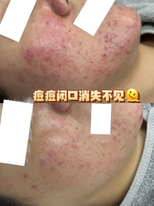 祛痘手术真能清理毛孔吗？-图2