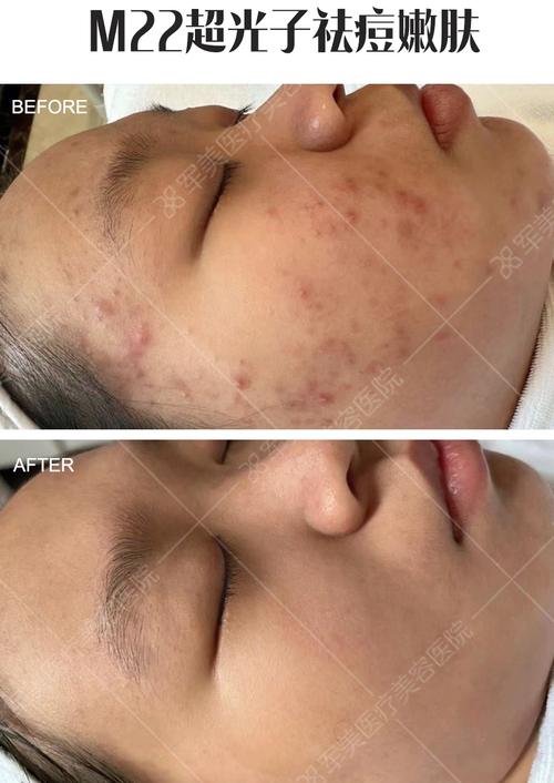 光子祛痘印后如何做好后期保养？-图1