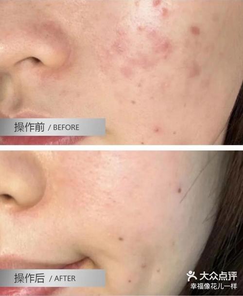 光子祛痘印后如何做好后期保养？-图2