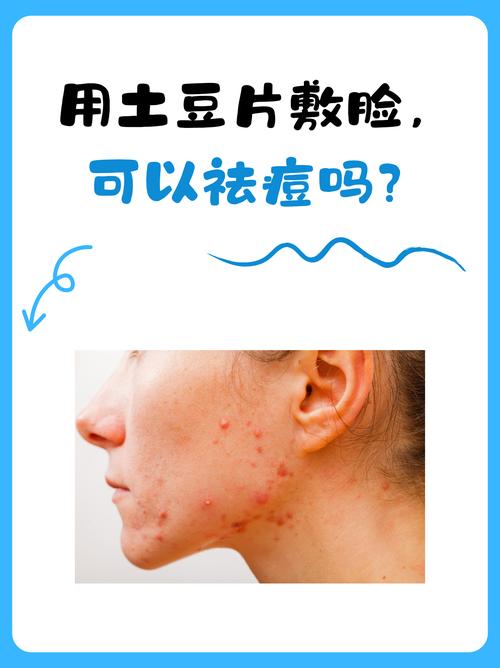 土豆真的能祛痘印吗？-图1