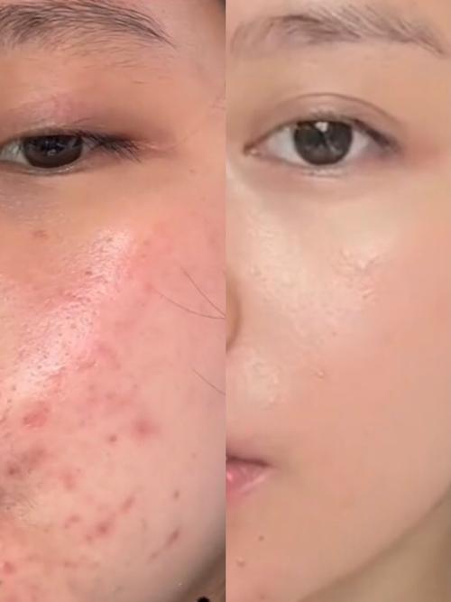 祛痘后能马上化妆吗？-图1