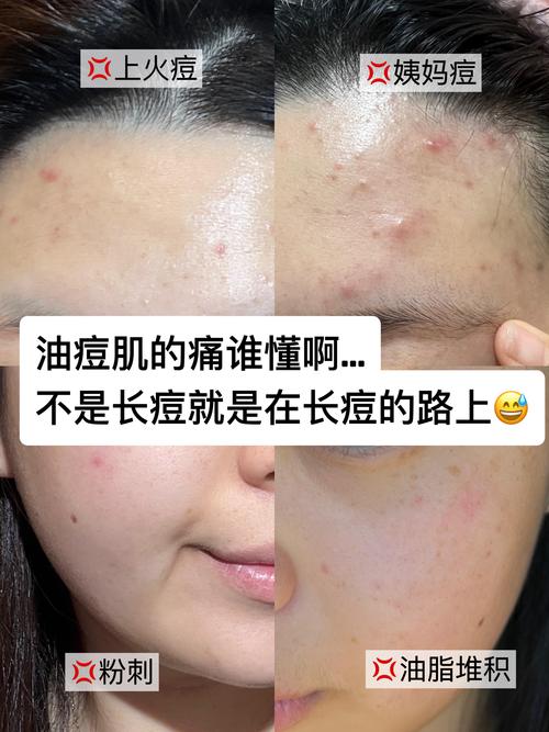 祛痘后能马上化妆吗？-图2