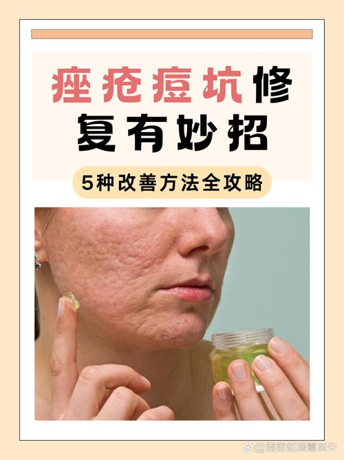 祛痘面膜后需要洗脸吗？-图3