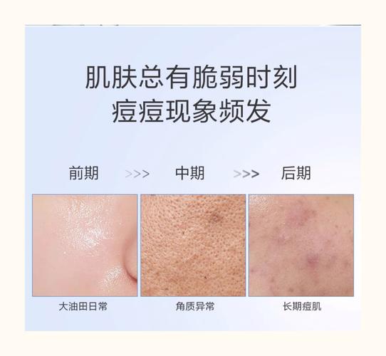 喝什么水能快速祛痘？-图3