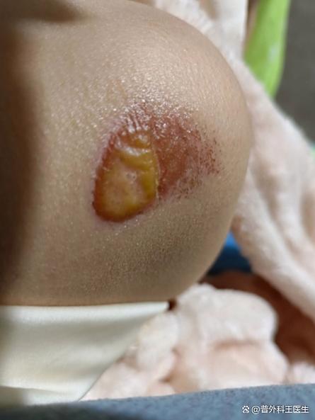 祛痘药膏涂后为何化脓？-图1