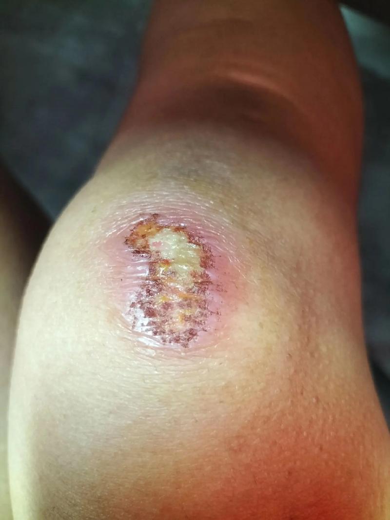 祛痘药膏涂后为何化脓？-图2