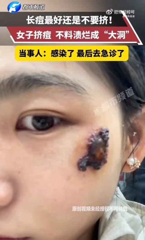 祛痘药膏涂后为何化脓？-图3