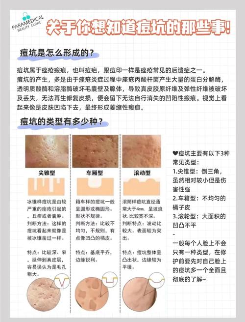 祛痘印先补水还是消炎？-图2