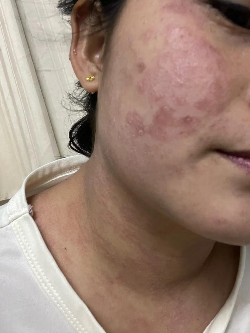 祛痘药膏用后蜕皮正常吗？-图1