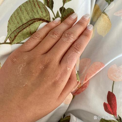 祛痘药膏用后蜕皮正常吗？-图2