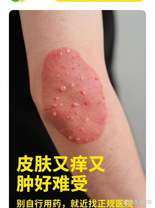 祛痘药膏用后蜕皮正常吗？-图3