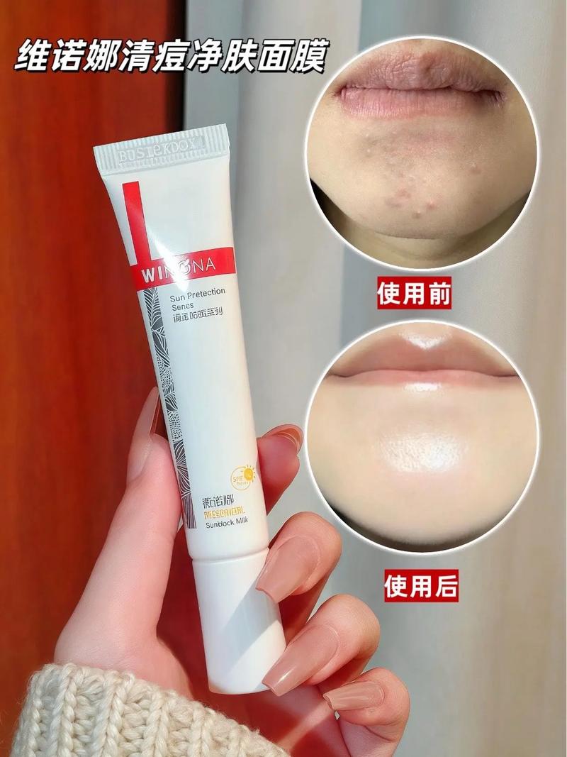 祛痘达人面膜真的好用吗?-图1 祛痘达人面膜真的好用吗?-图1