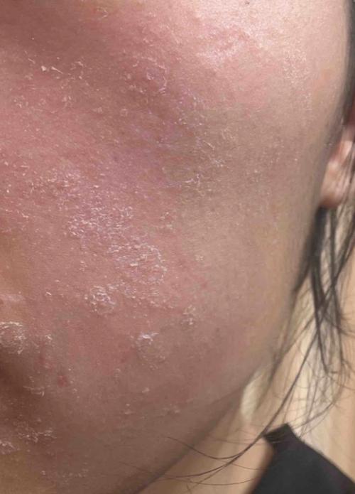 涂抹祛痘药膏全脸蜕皮-图1 涂抹祛痘药膏全脸蜕皮-图1