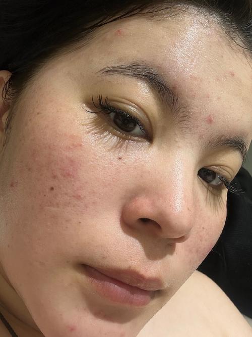 涂抹祛痘药膏全脸蜕皮-图3 涂抹祛痘药膏全脸蜕皮-图3