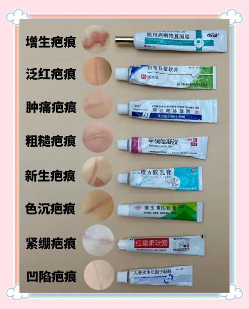 祛痘印疤痕,哪种方法最有效?-图2 祛痘印疤痕,哪种方法最有效?-图2