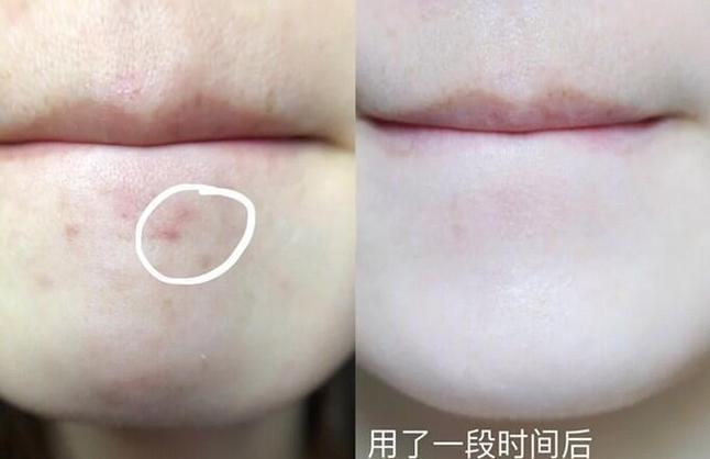 土豆祛痘印的原理是什么?-图2 土豆祛痘印的原理是什么?-图2
