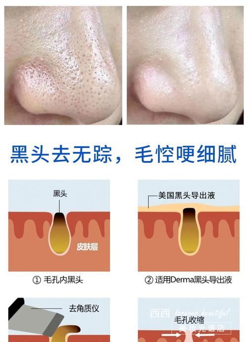 缩毛孔去黑头,护肤品真的能同时搞定吗?-图2 缩毛孔去黑头,护肤品真的能同时搞定吗?-图2