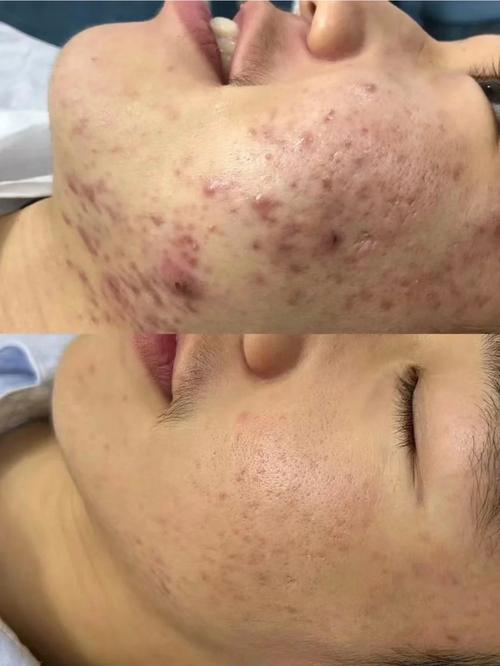 激光祛痘印效果最好的方法是什么？-图1