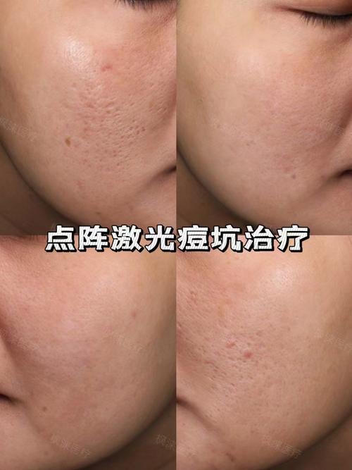 激光祛痘印效果最好的方法是什么？-图2
