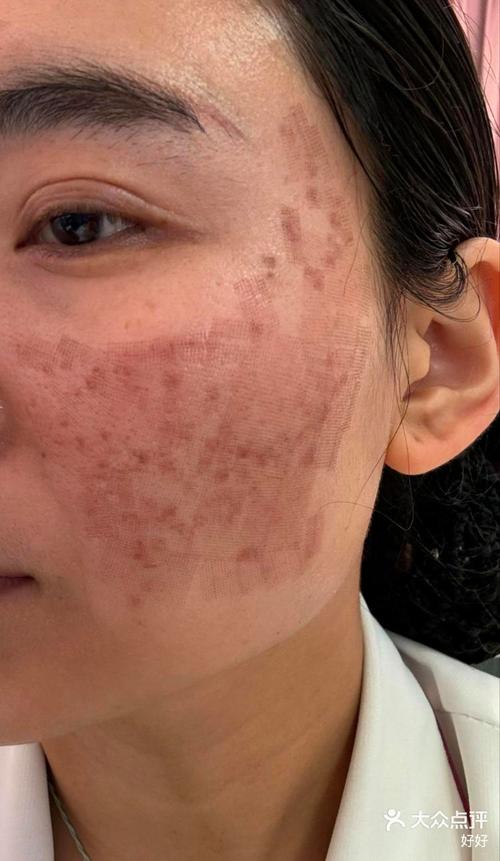 激光祛痘印效果最好的方法是什么？-图3