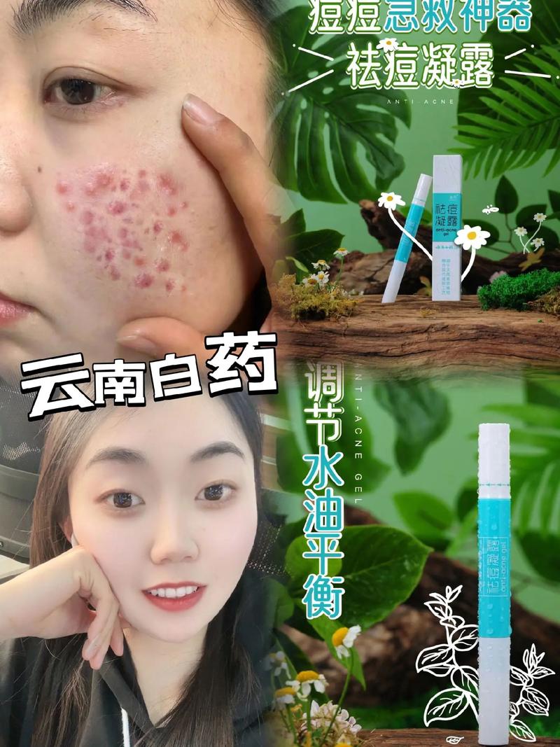 多肽祛痘凝露哪里有?-图2