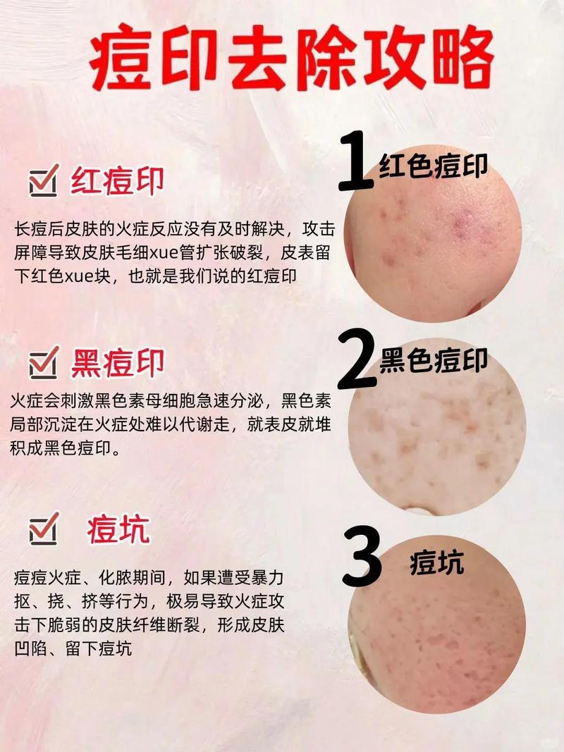 祛痘印偏方 有效果吗-图3