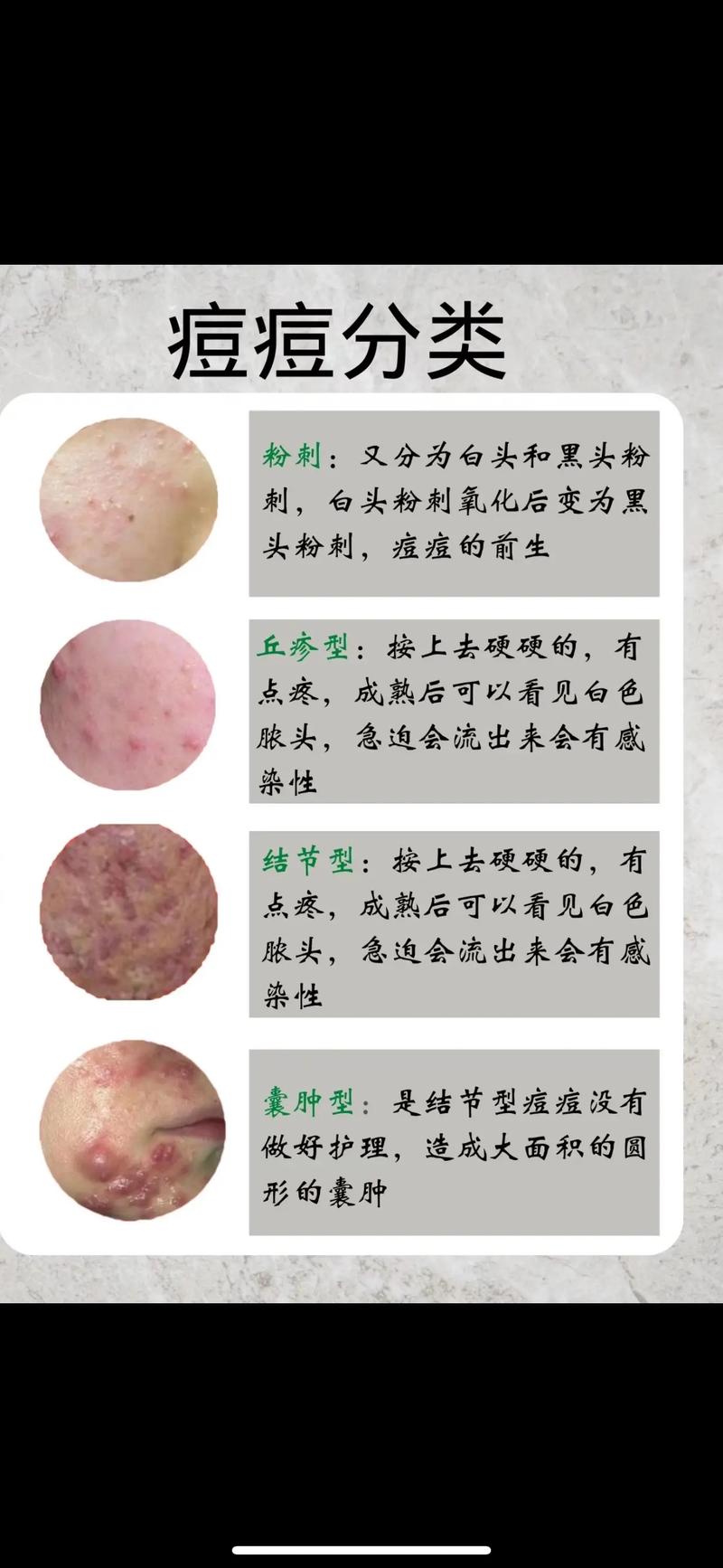 青少年如何有效控油祛痘？-图3