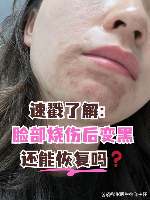 狮王祛痘会烧伤皮肤吗？-图2