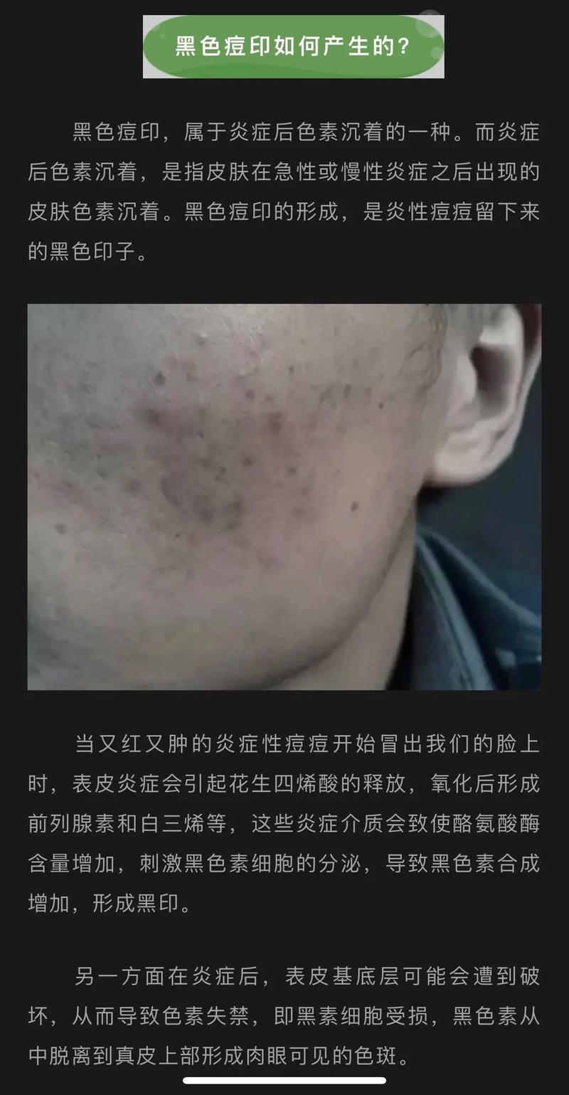 痘印黑色怎么快速祛除？-图1