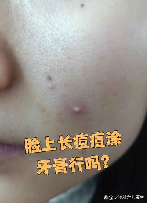 长痘脸能不能去角质？-图2