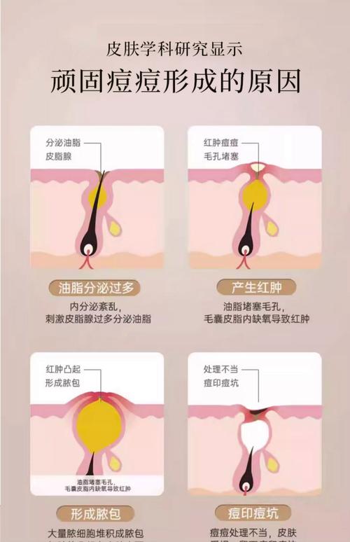 京润祛痘精华正确用法是什么？-图1