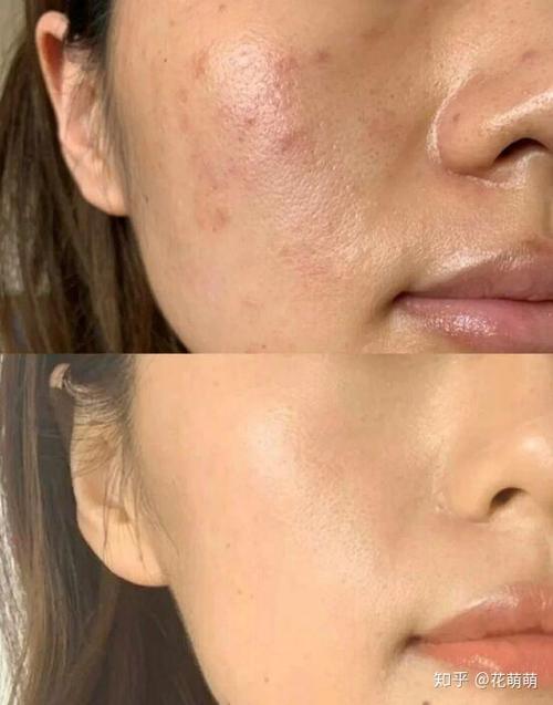 跑步能祛痘印吗？-图2