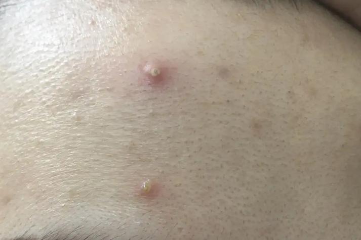 男士油痘肌如何快速消脓包?-图1 男士油痘肌如何快速消脓包?-图1