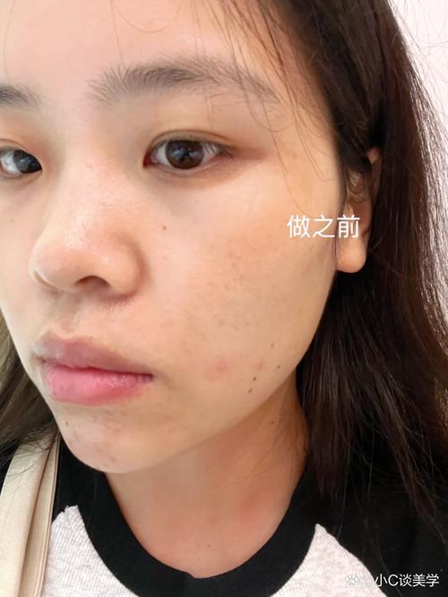 VE戳破能祛痘吗?-图2 VE戳破能祛痘吗?-图2