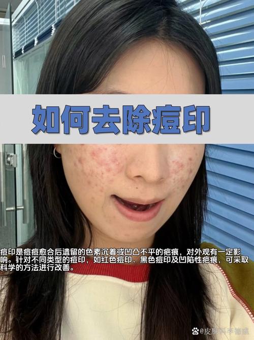 VE戳破能祛痘吗?-图3 VE戳破能祛痘吗?-图3