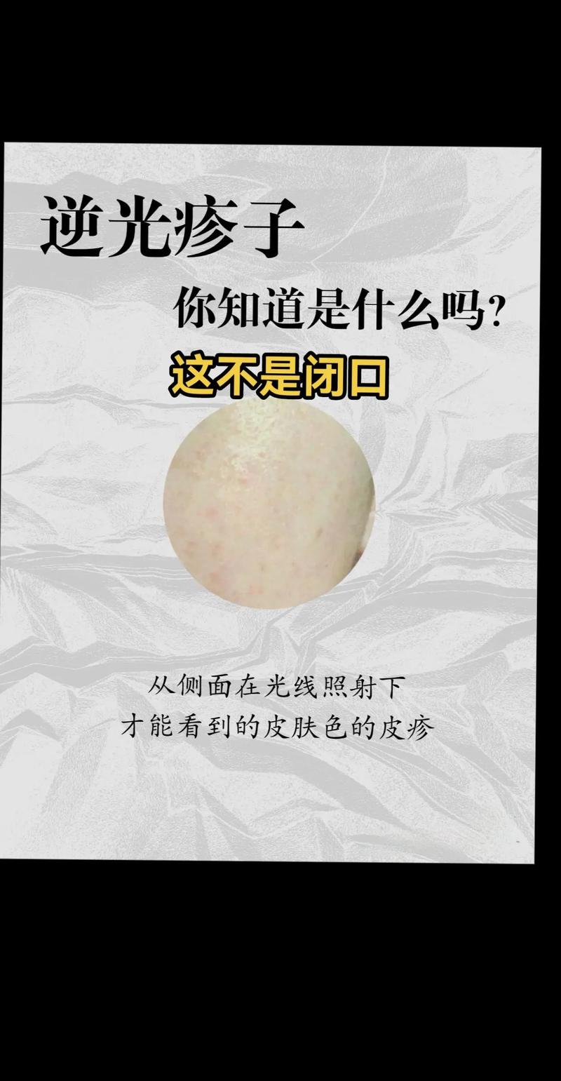 强脉冲光到底能不能祛闭口痘？-图1