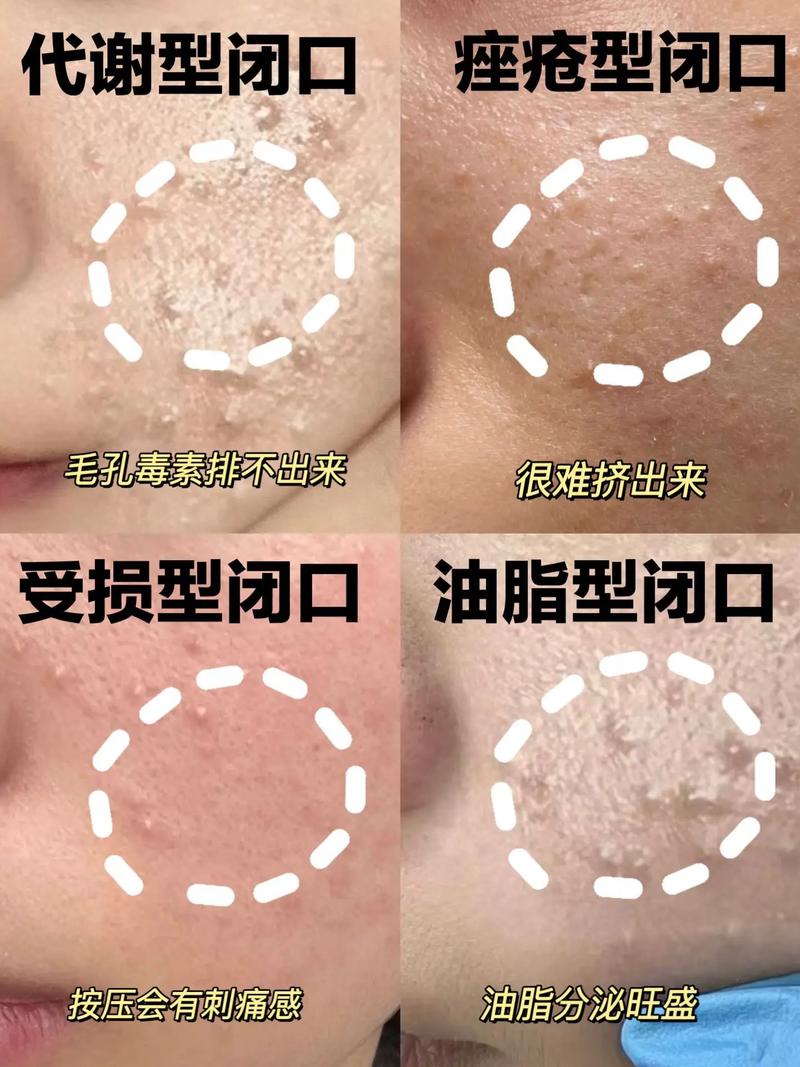 强脉冲光到底能不能祛闭口痘？-图3