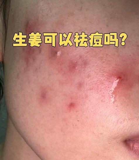 姜汁祛痘印真有效吗？-图3
