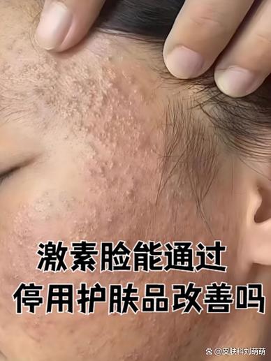 韭菜擦脸真能祛痘吗？-图1