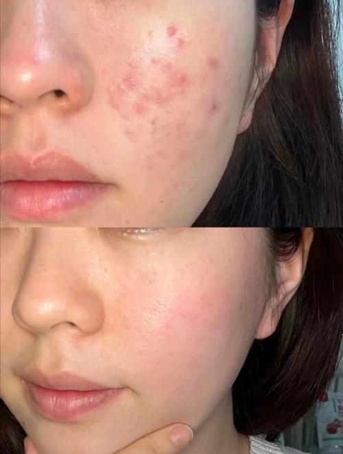 祛痘产品致痒疹怎么办？-图3