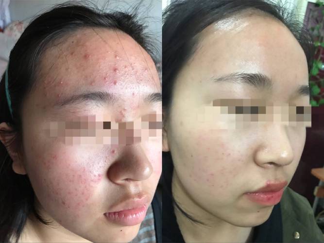 祛痘产品致脸毁容，该找谁负责？-图1