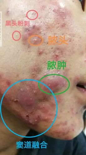 祛痘产品致脸毁容，该找谁负责？-图2